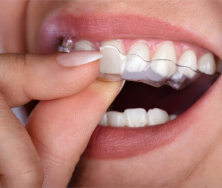 Dental implant