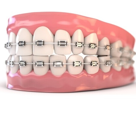 Dental implant