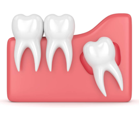 Dental implant